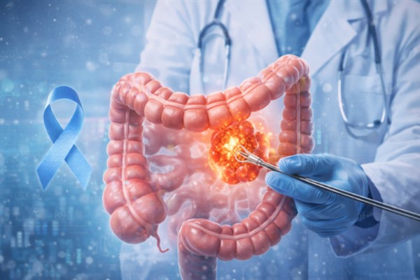 Kolon Kanseri Farkındalık Ayı’nda erken teşhis uyarısı Kolon Kanseri Farkındalık Ayı’nda erken teşhis uyarısı